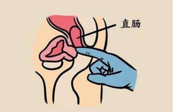 这三大误区，会让你错过直肠癌的最佳治疗期