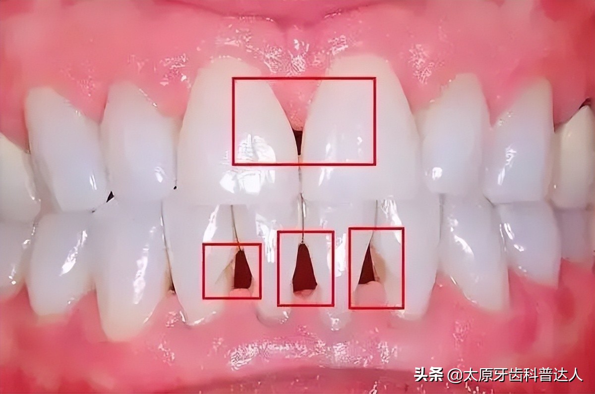 牙齿出现黑三角如何解决,牙齿出现黑三角有什么危害