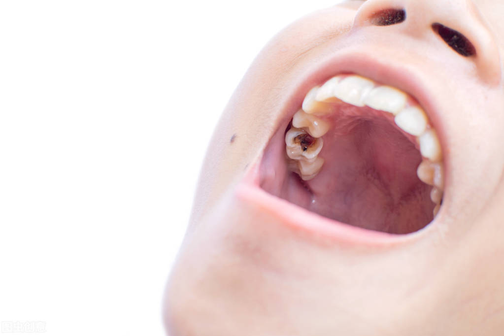 蛀牙痛怎么止痛最快最有效,蛀牙痛怎么缓解疼痛