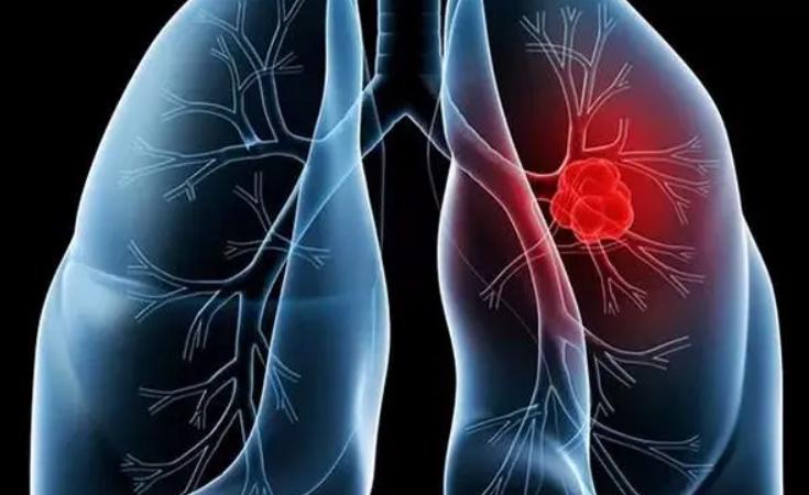 右肩疼了6个月查出肺癌，身上5处出现疼痛，或是癌症和疾病的征兆