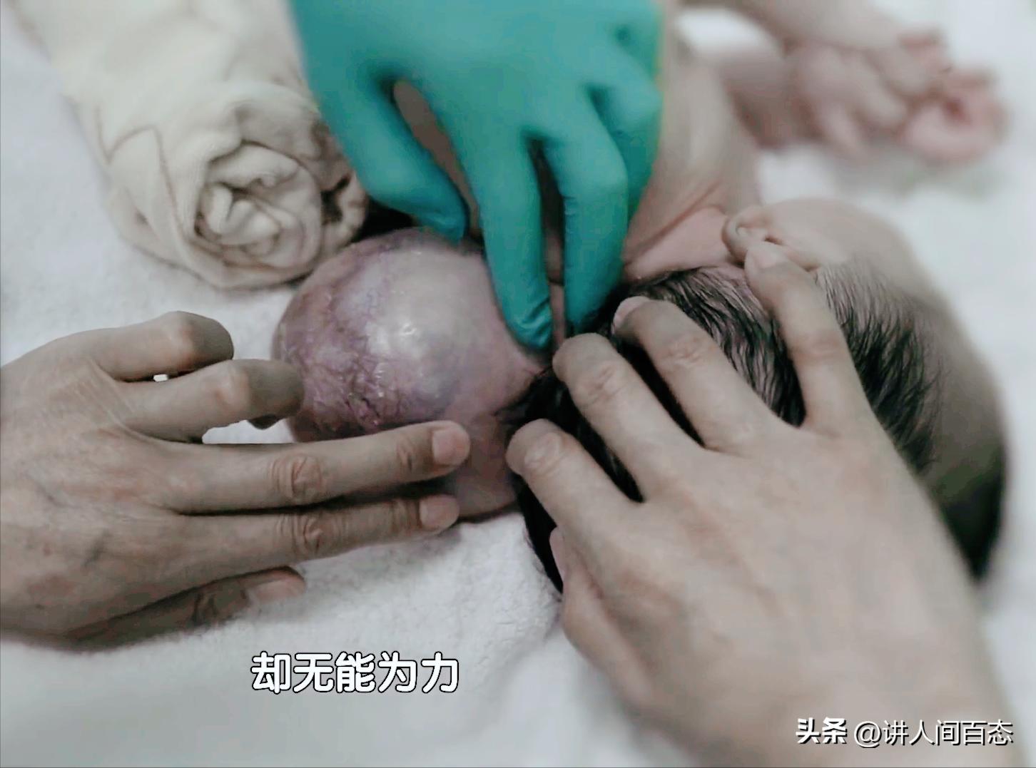 被丢在桥洞下的孩子后续,孩子被遗弃后脑长肿瘤