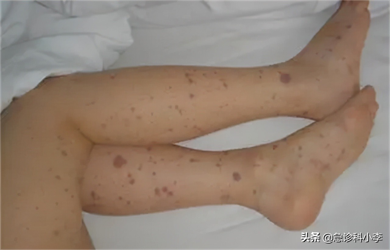 身上出现不痒的小红点是怎么回事,身上突然起了很多小红点不痛不痒