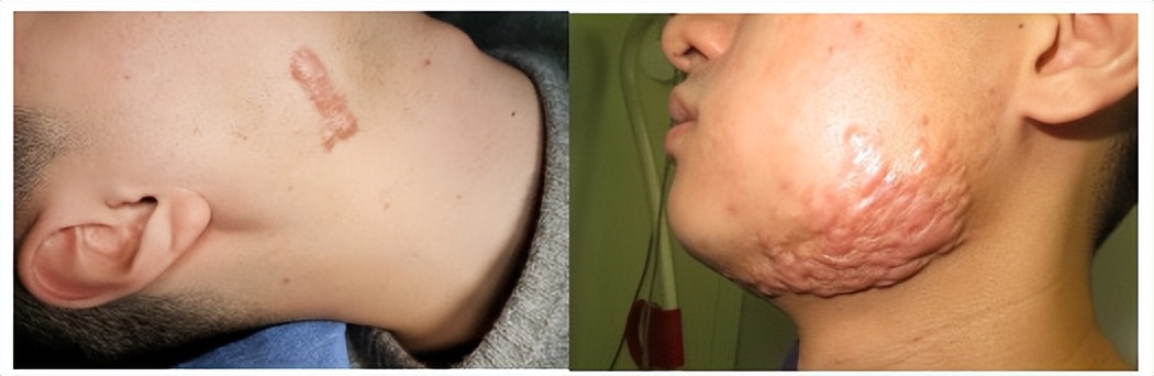 最难愈合的疤痕,无法治愈的疤痕