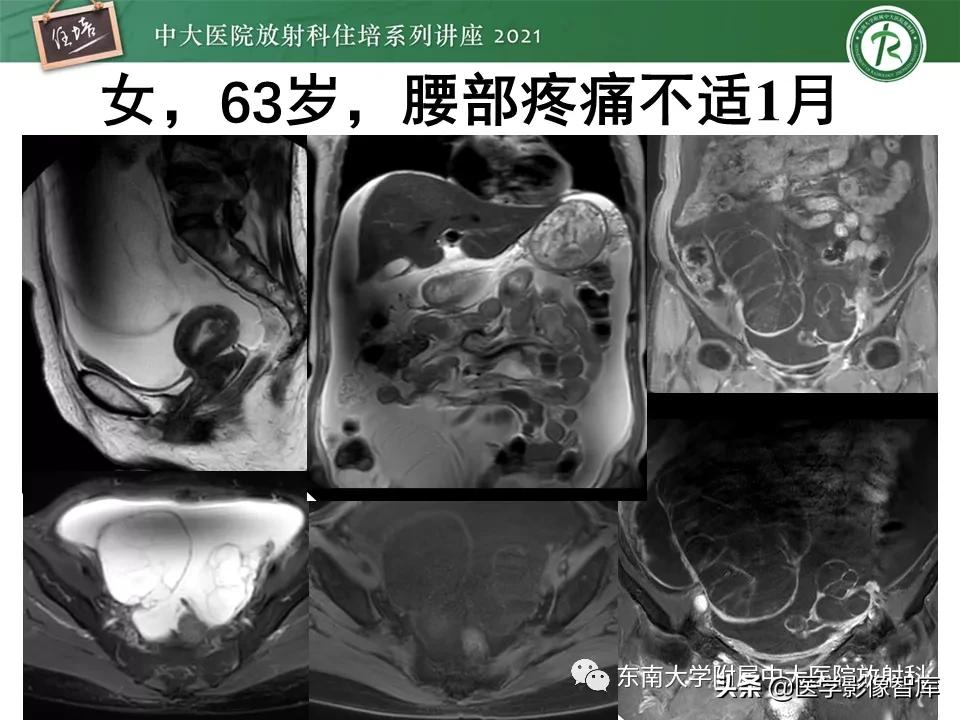 卵巢浆液性肿瘤的肉眼及镜下特征,卵巢原发性粘液性囊腺瘤