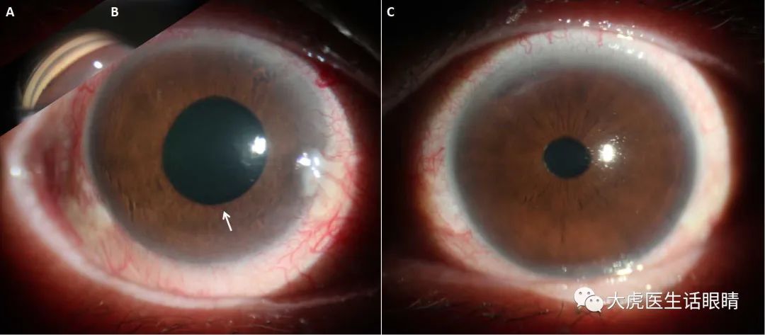 放射性视神经病变,放射性脑炎影像表现