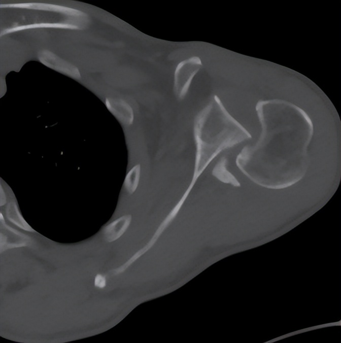 陈旧性肩关节脱臼有必要做手术吗,多年陈旧性肘关节脱臼