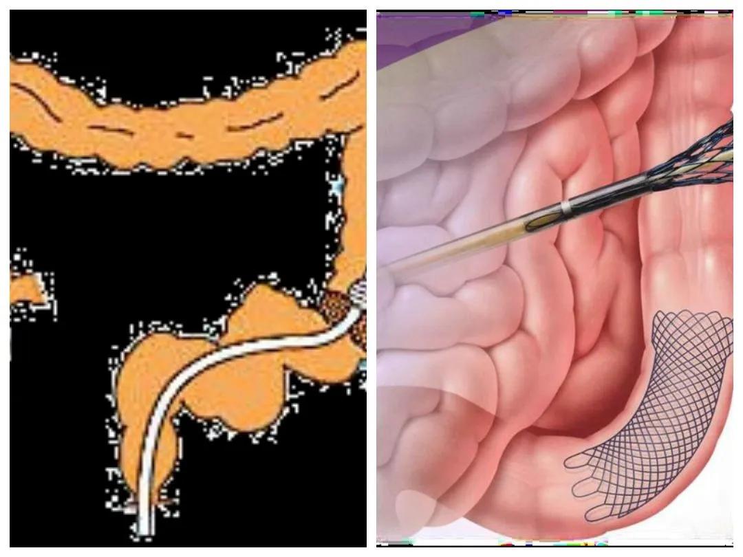 直肠癌肝转移最先进治疗方法,直肠癌的治疗方法是什么