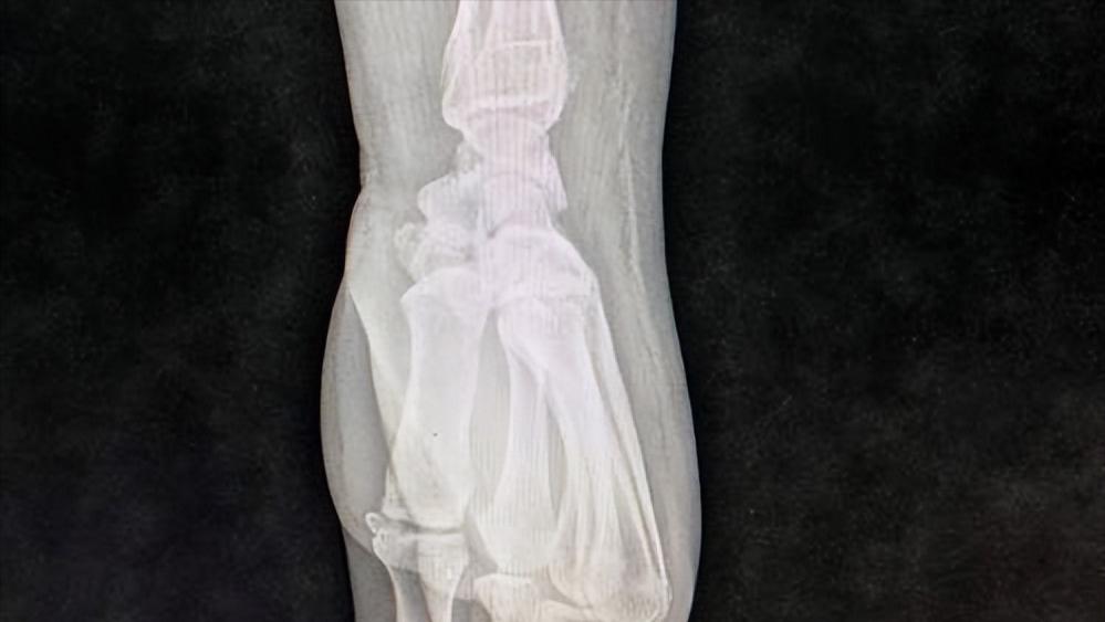 慢性肾衰会引起膝盖疼吗,肾衰病人小脚骨疼是什么原因