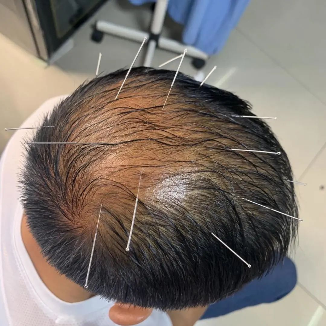 发际线处头发稀少怎么调理,中医怎么治疗发际线高头发稀少