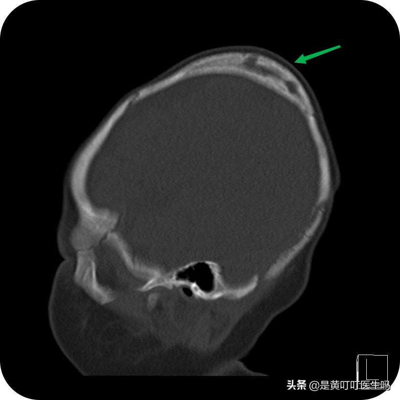 婴儿头部畸形一边大一边小,宝宝刚出生时头顶肿了一个大包