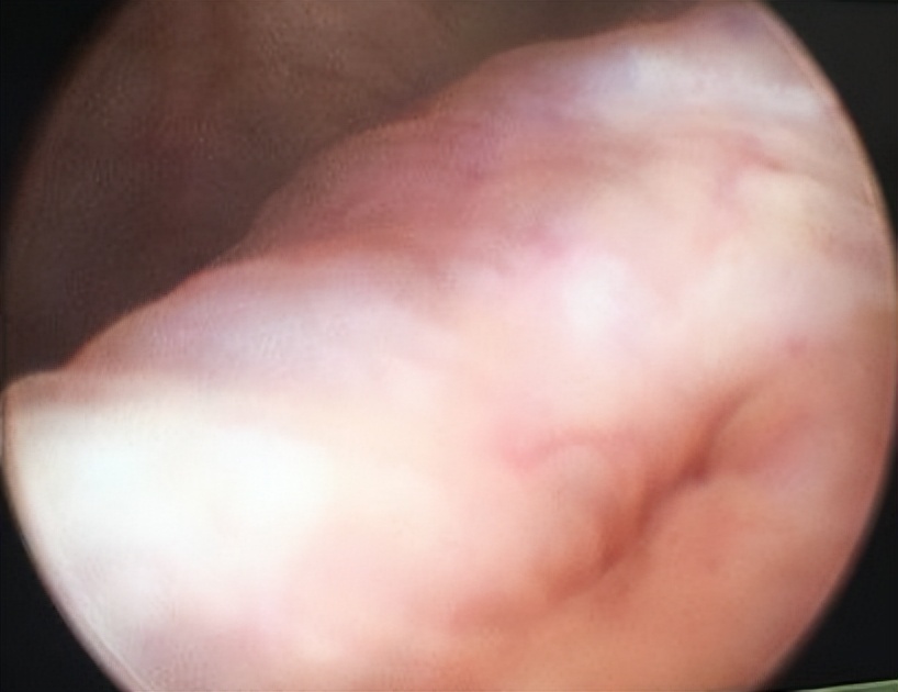 明知山有虎,偏向虎山行——肾斗士VS肾结石