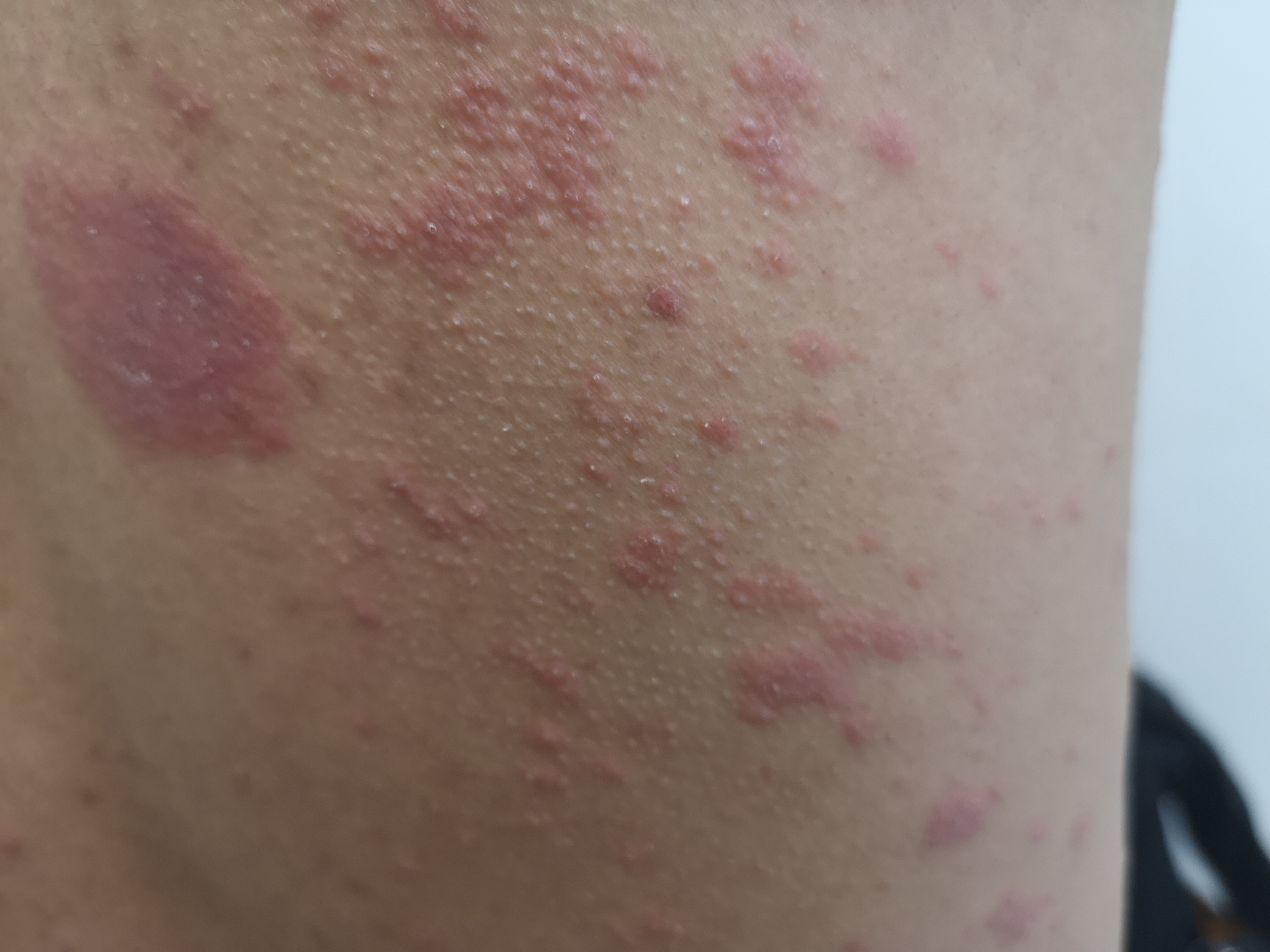 对镍过敏是怎么回事,镍过敏的人多不多