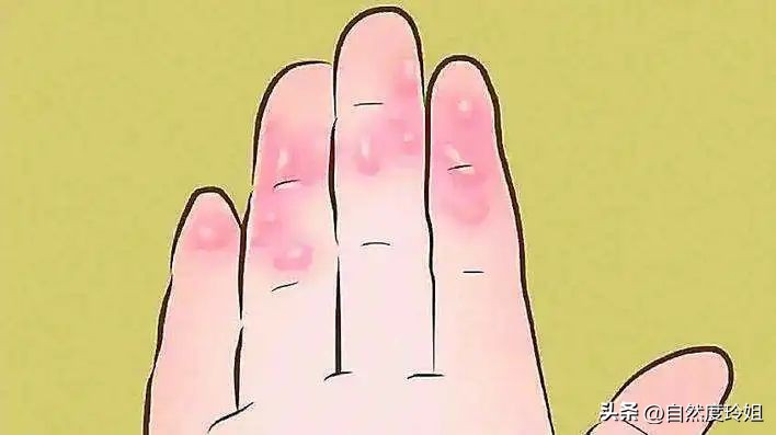 手脚突然起小水泡很痒怎么办,手脚一到夏天就起水泡