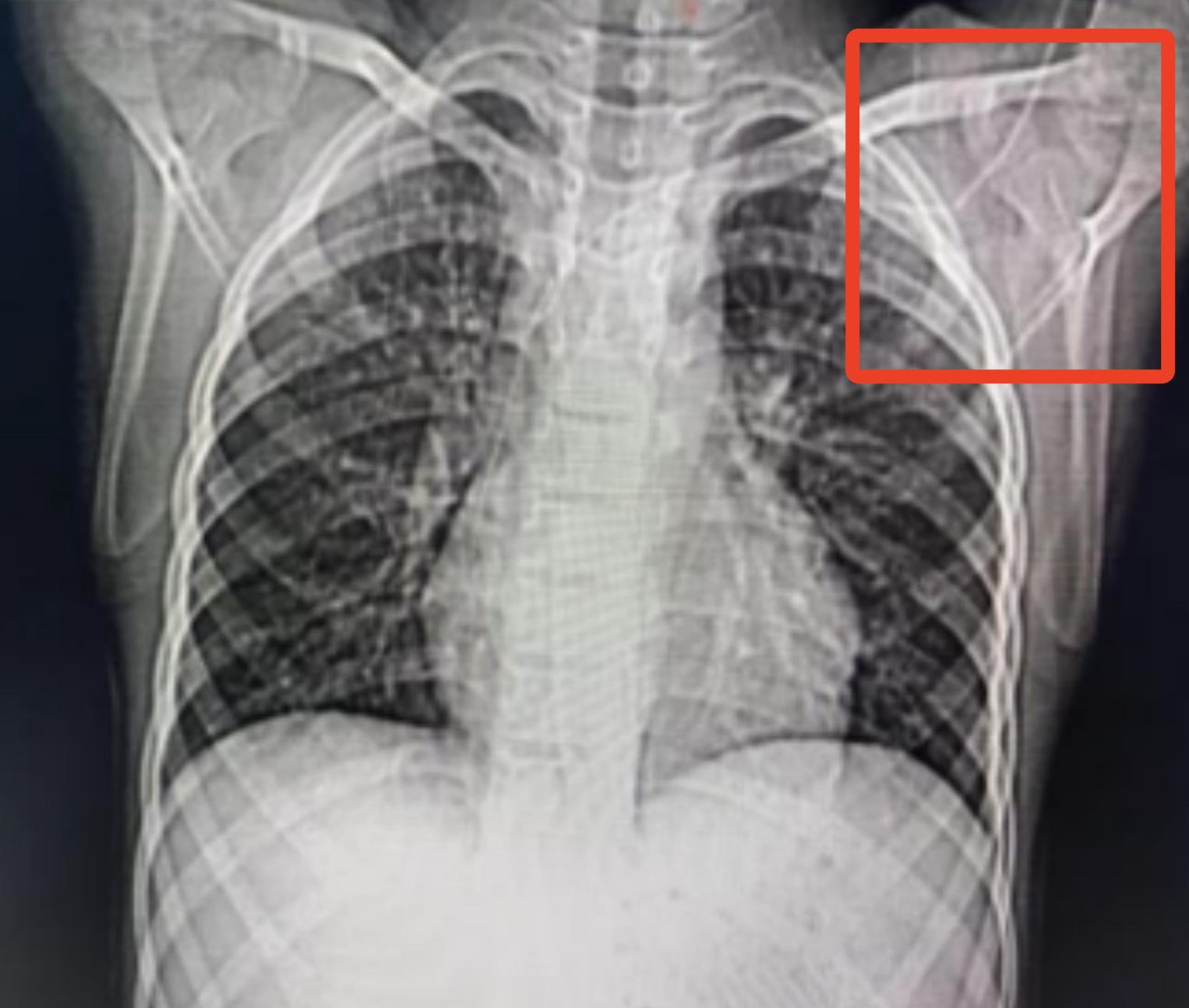 picc导管体外接头断裂,picc导管断裂的应急预案及流程