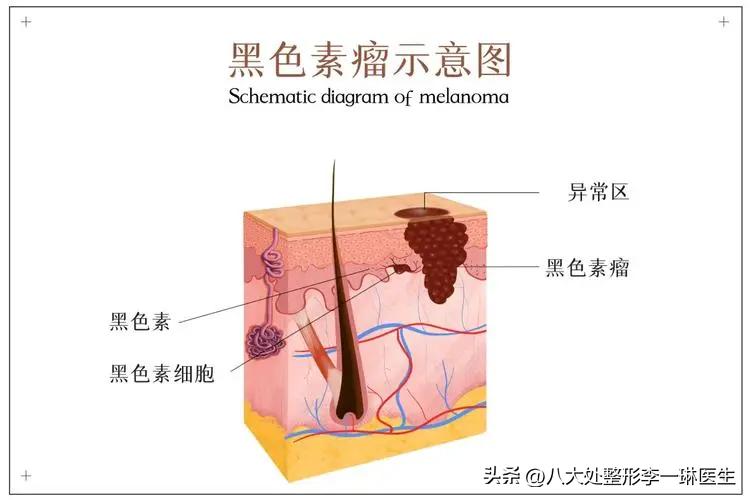 黑色素瘤与普通色素痣区别,原位黑色素瘤和黑色素痣的区别