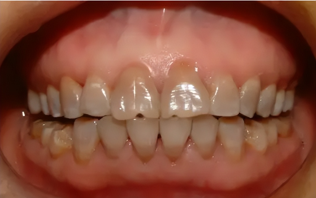 牙齿美白神器真的靠谱吗,牙齿美白产品测评真实有效