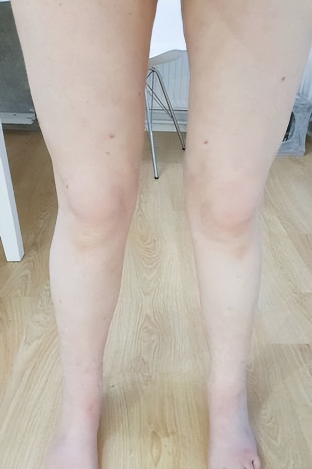 女子因癌症截肢,女子重病瘫痪20年最后被发现