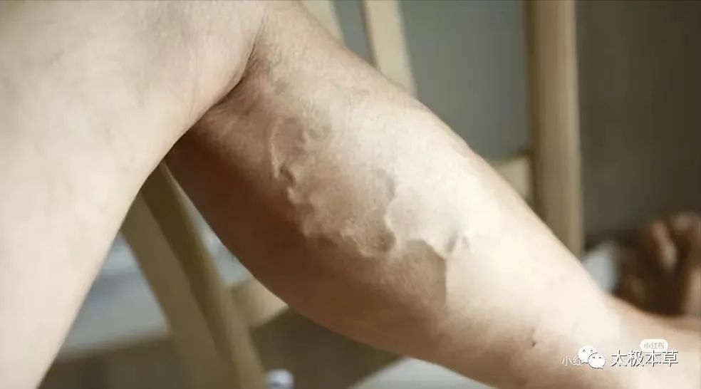 李卓杰治下肢静脉曲张验方,精索静脉曲张中药验方