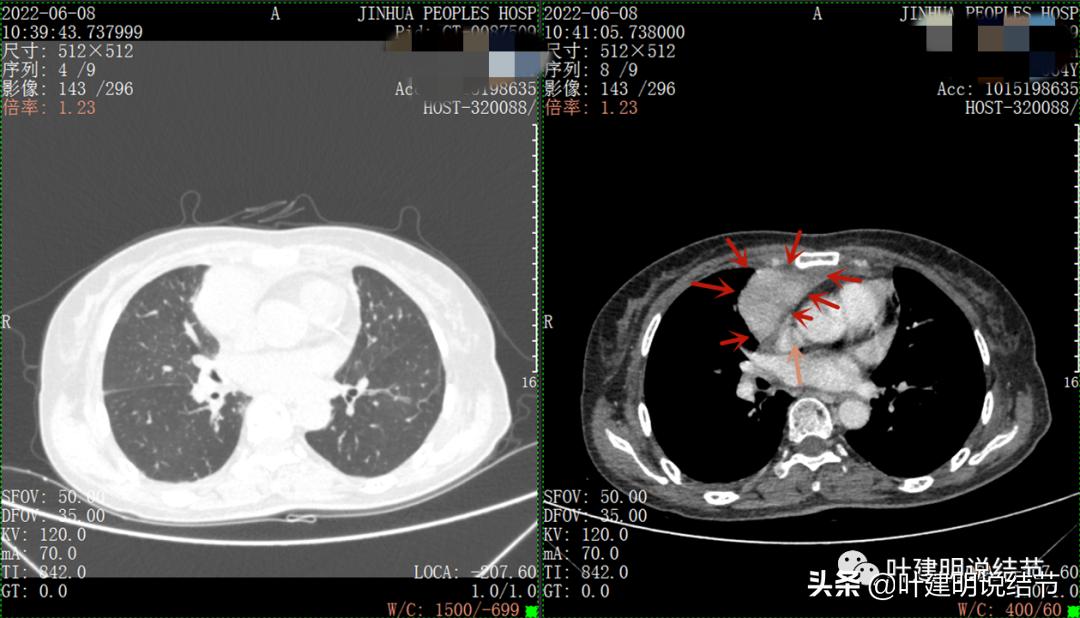 这位老乡，乏力来查，查出这么大个的纵隔肿瘤！会是什么呢？