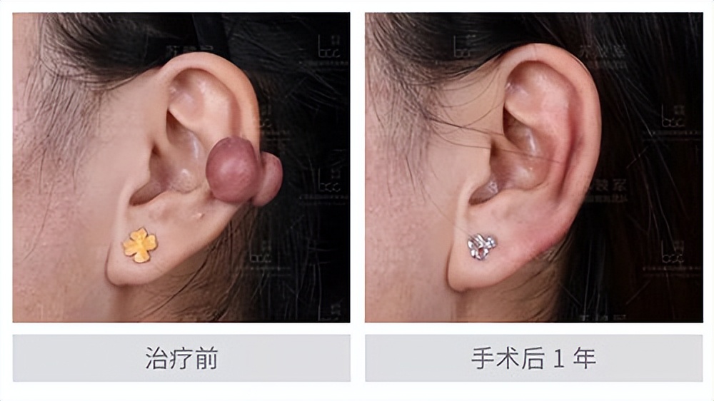 耳朵长疤痕疙瘩可以用绳子拴住吗,耳朵长疤痕疙瘩切除后多久再长
