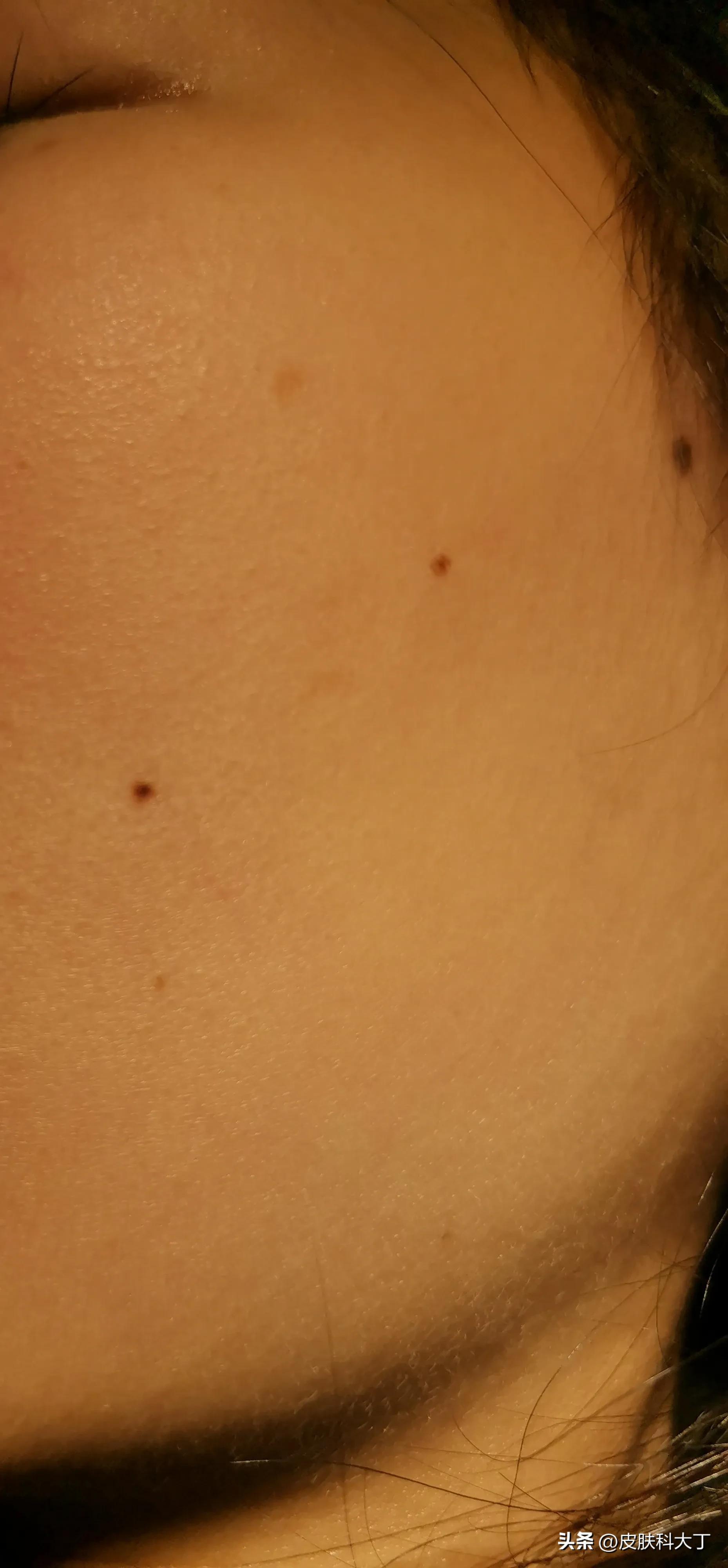 脸上的痣用激光点会留疤吗,脸部激光点痣后的注意事项