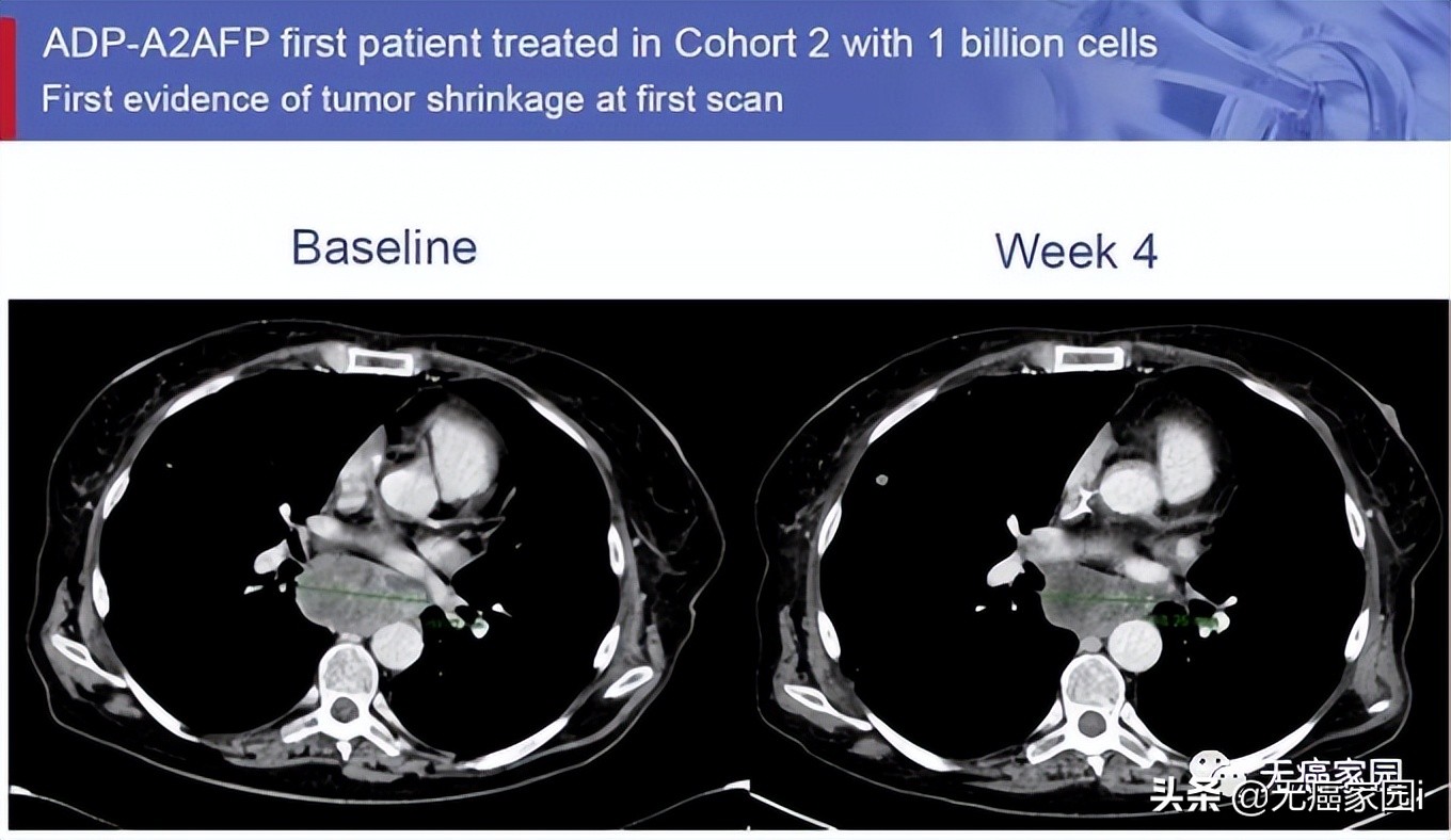 细胞免疫疗法治疗癌症,细胞免疫疗法能治愈癌症吗