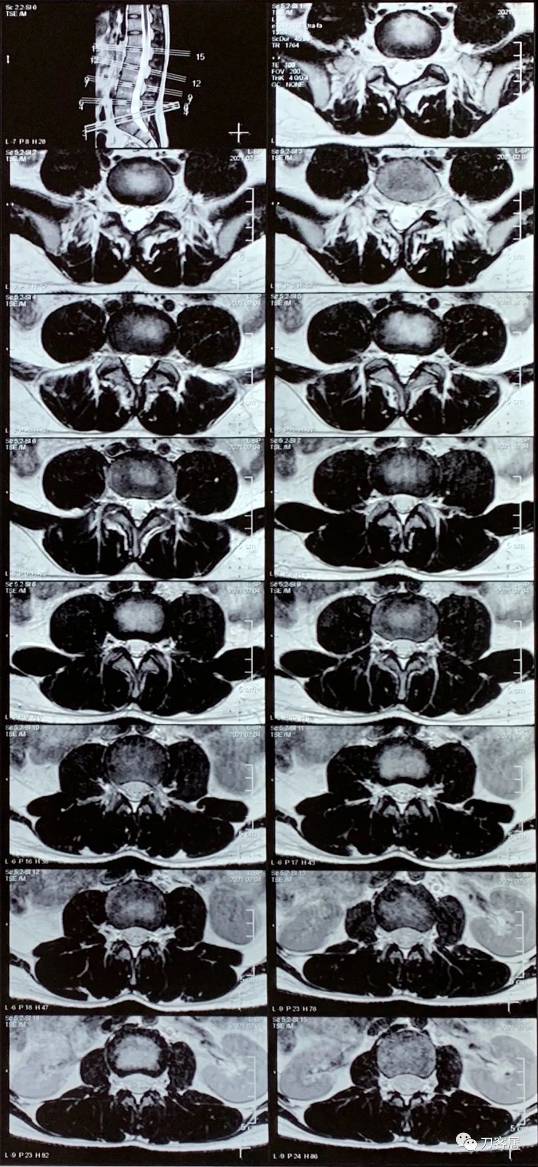 20岁出现峡部裂建议手术吗,20岁腰峡部裂了要不要手术