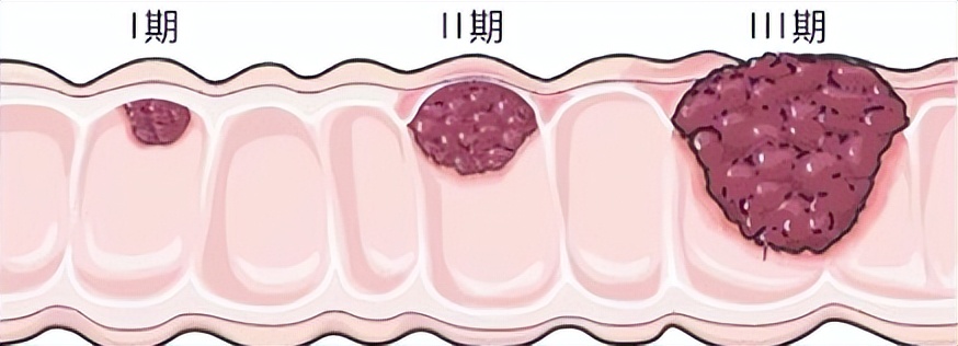 息肉一定会癌症吗,增生息肉切完会癌变吗