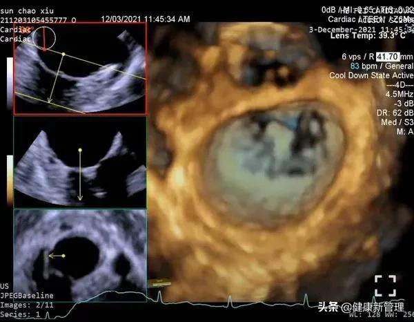 二尖瓣微创钳夹术全过程怎么做,二尖瓣微创钳夹术视频