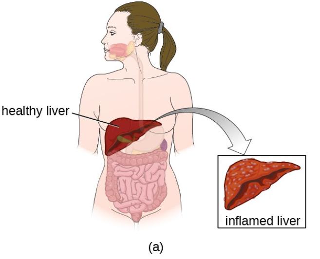 鐢峰瓙鍙嶅鍙戠儹绔熸槸鎮ｄ簡鑲濆惛铏梾,鑲濋儴鎰熸煋瀵勭敓铏槸鎬庝箞鍥炰簨
