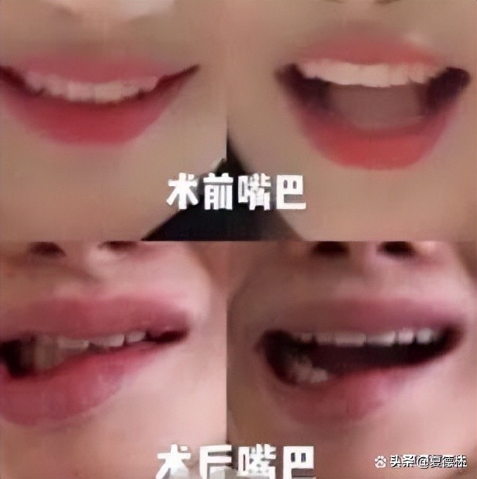 削骨和磨骨区别后遗症,削骨和磨骨的区别和危害