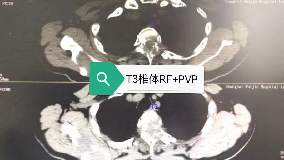 病例Ⅴ：RF+PVP联合治疗高位胸椎溶骨性转移瘤及压缩骨折