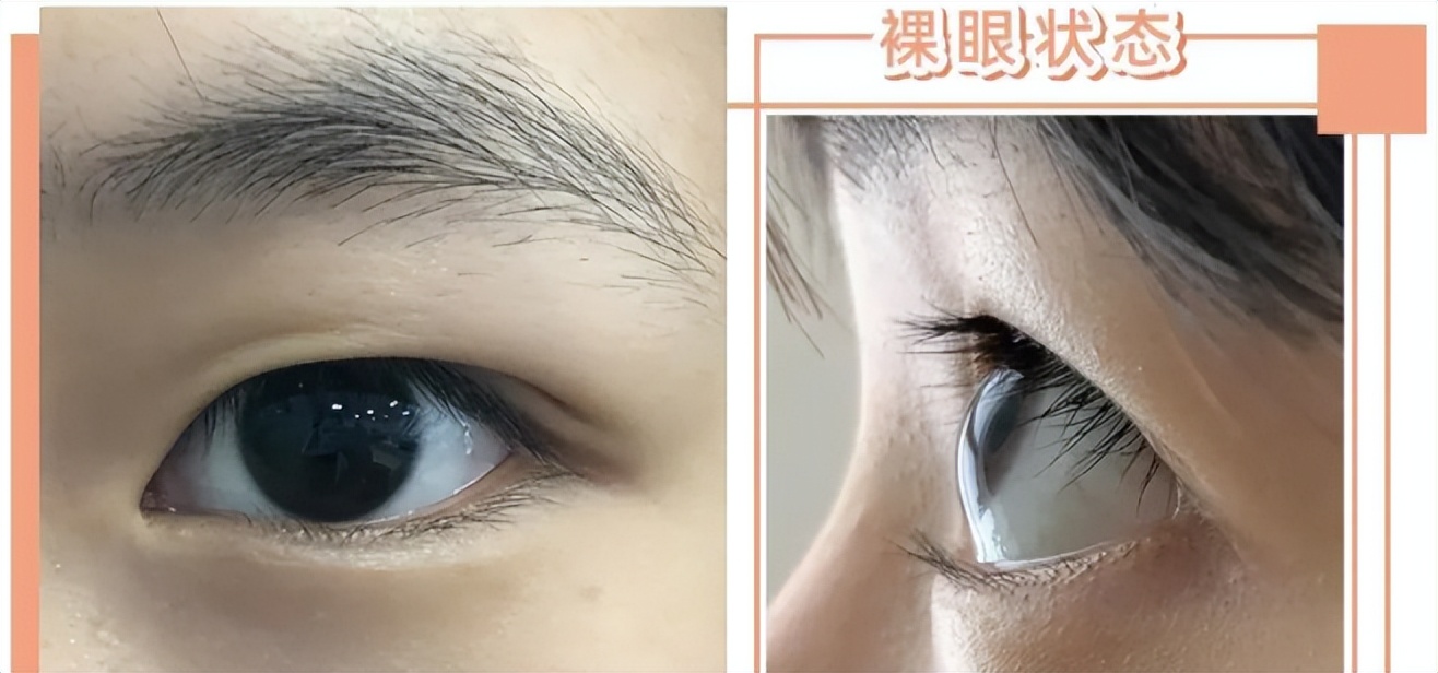 单眼皮肿眼泡如何不贴双眼皮消肿,单眼皮肿眼泡怎么消肿最快