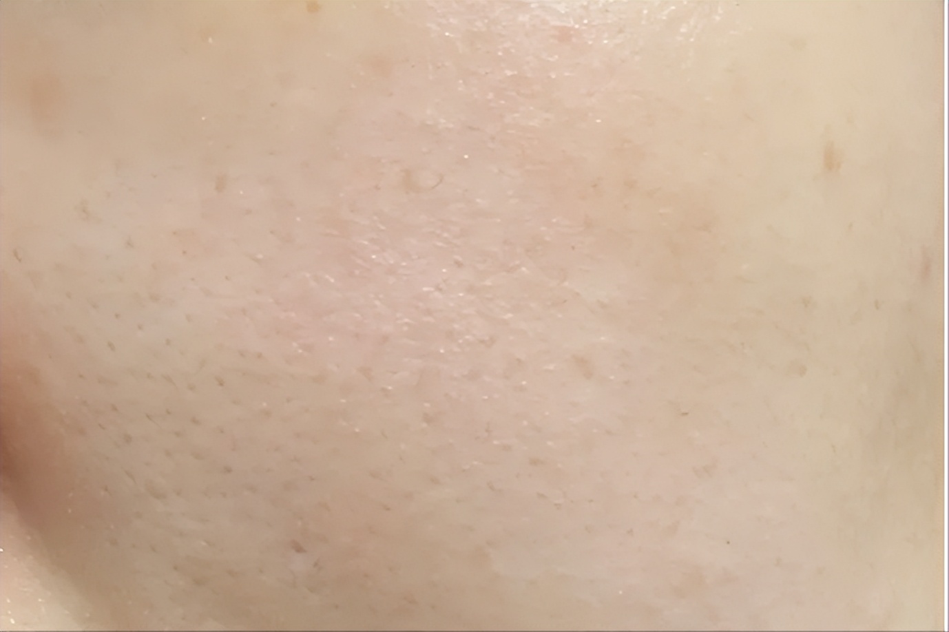 甲硝唑和壬二酸正确时间使用方法,甲硝唑和壬二酸要洗掉吗