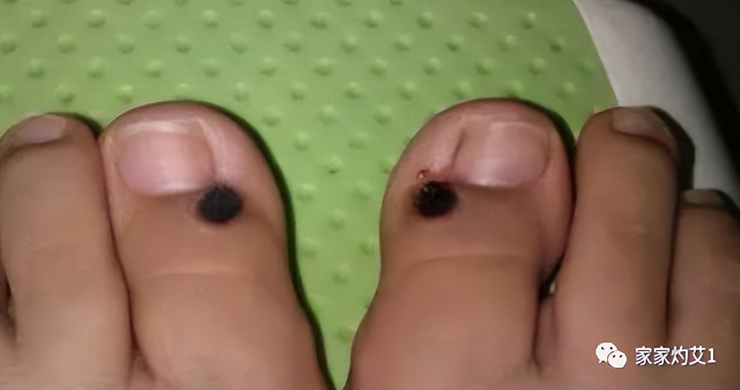 麦粒灸关元视频,麦粒灸隐白穴止血一天几次