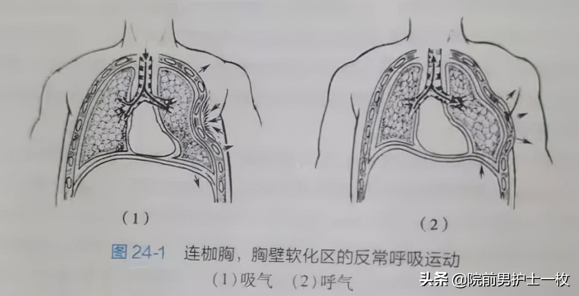 多发肋骨骨折的处置措施