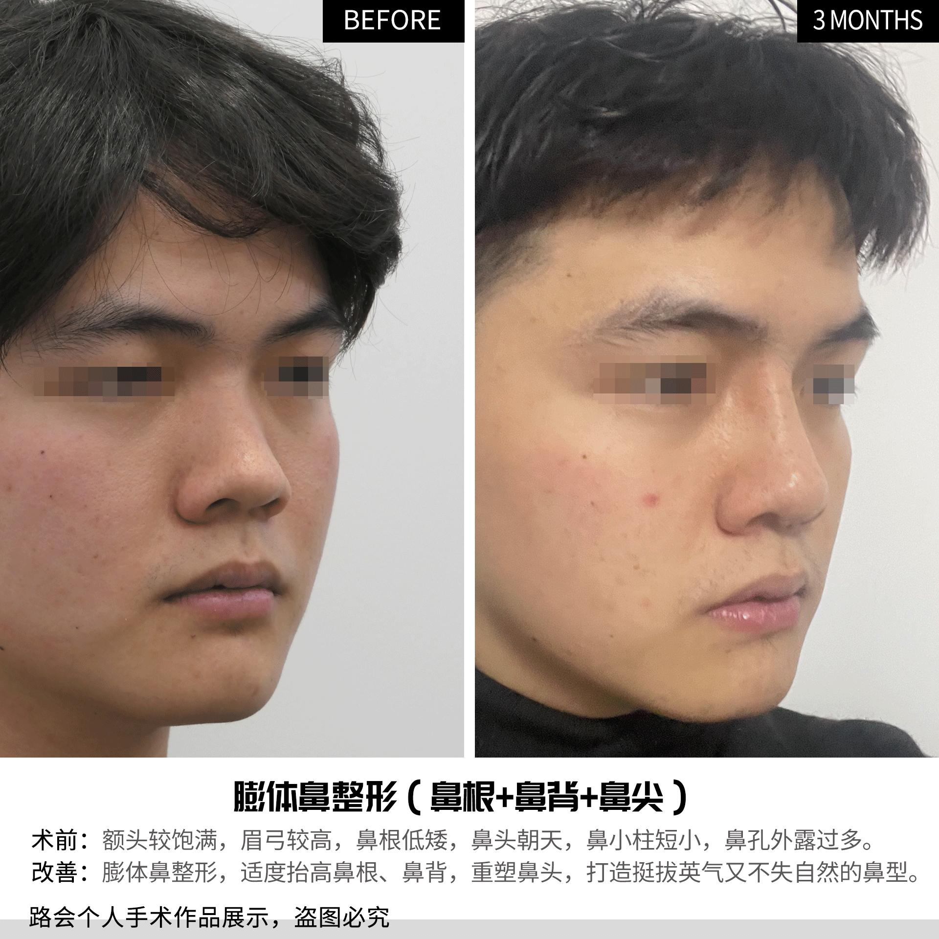 24岁小伙子隆鼻,隆鼻手术效果图解对比照
