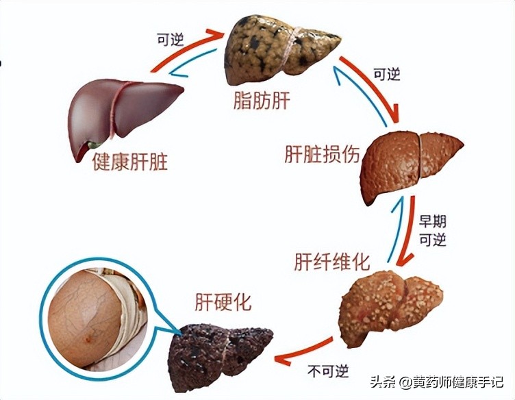 护肝降转氨酶的中成药物大全,脂肪肝性肝炎吃什么中成药