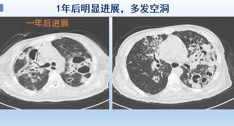 患有肺结核注意事项,19岁肺结核多久导致死亡