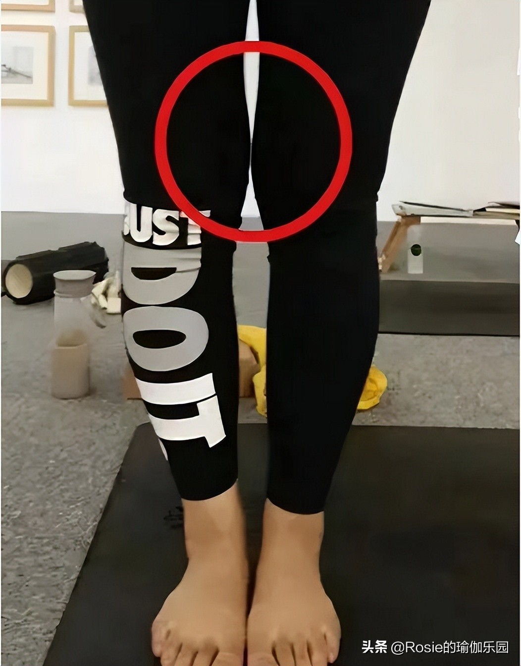 膝盖内侧鼓包怎么快速变直,膝盖外翻内侧鼓包如何消除