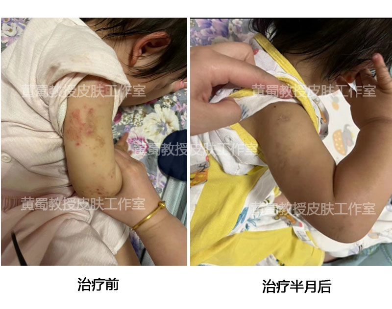 特应性皮炎中医疗法,特应性皮炎忌口食物一览表