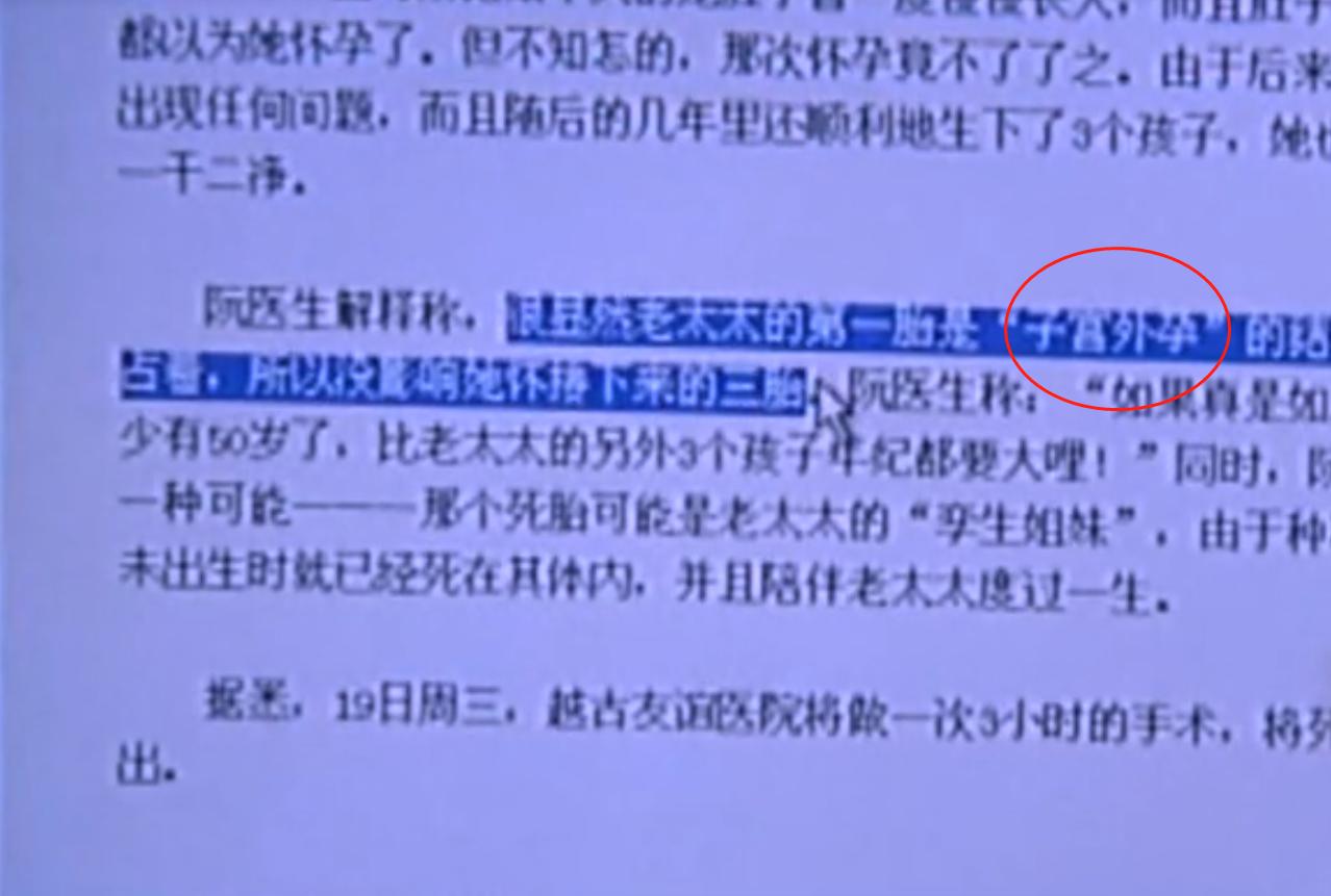 2007年四川90岁老妇，腹中怀子60年未生，后检查发现胎儿没有腐烂