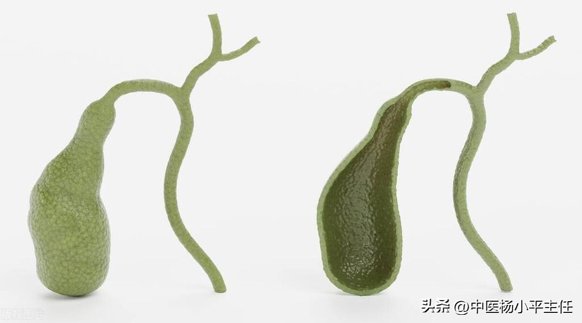 体检发现胆囊息肉7mm胆囊壁毛糙,体检发现有胆结石胆囊炎胆囊息肉