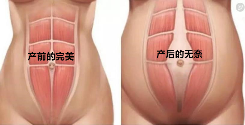 产后腹肉松垮,产后肚皮松像口袋一样