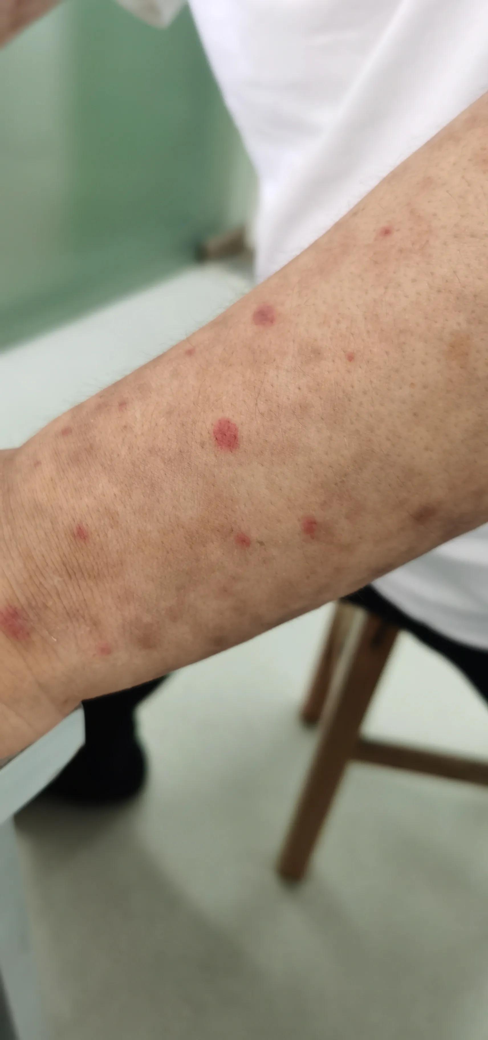 冠状动脉支架手术胳膊出现泡泡,冠状动脉支架术后头晕怎么处理