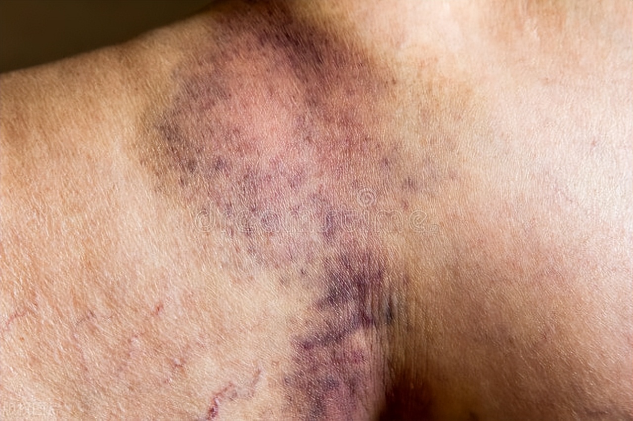 血小板减少会有哪些症状呢,免疫性血小板减少症症状