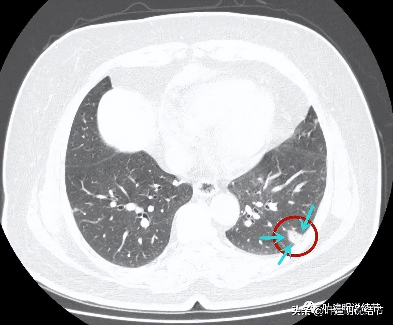 肺结节实性为什么建议抗炎治疗,肺上实性结节抗炎后变成空洞