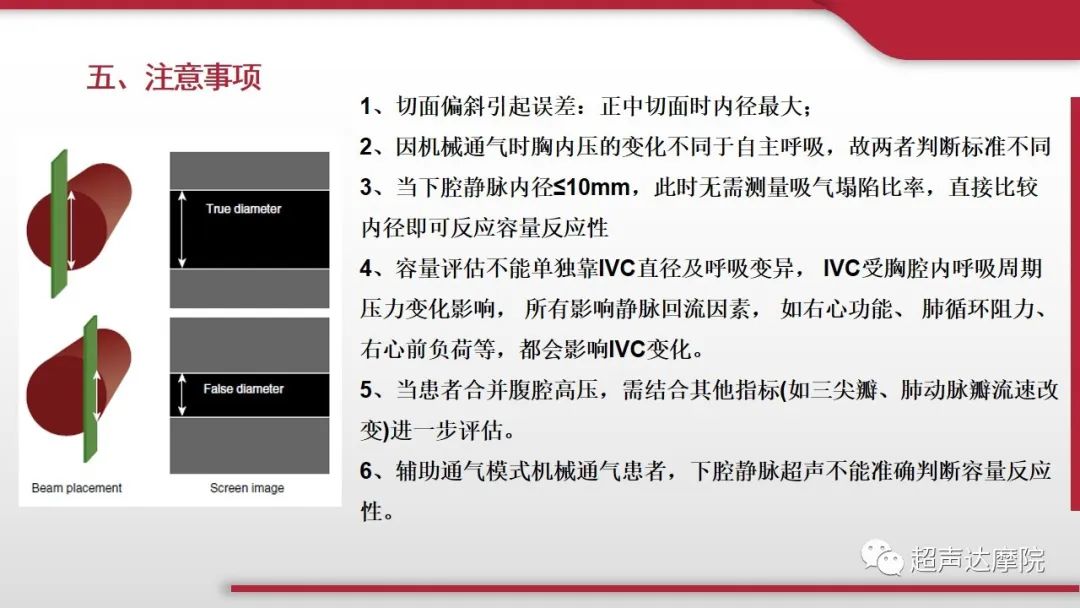 超声下腔静脉评估血容量,超声评估下腔静脉容量图片
