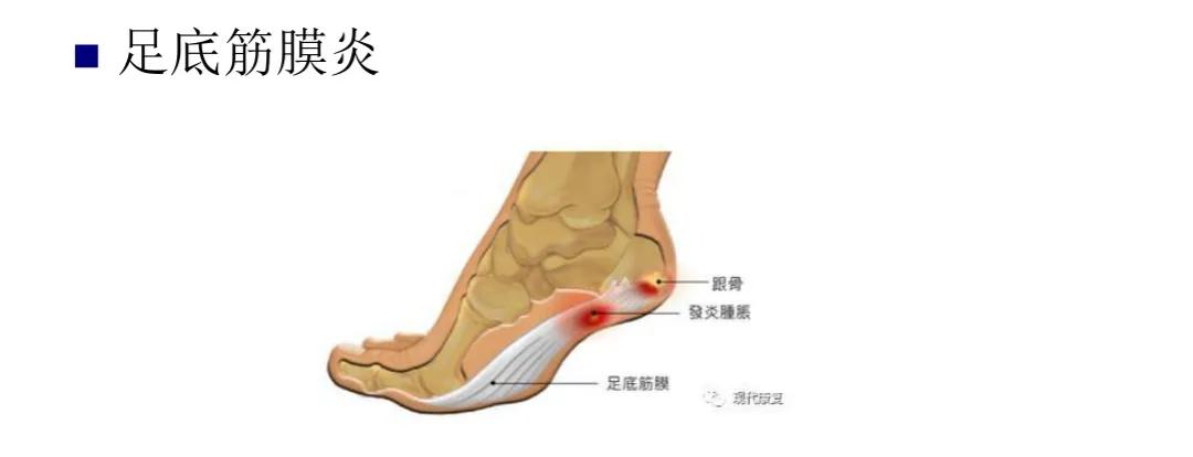 扁平足发病机制,扁平足诊断标准示意图