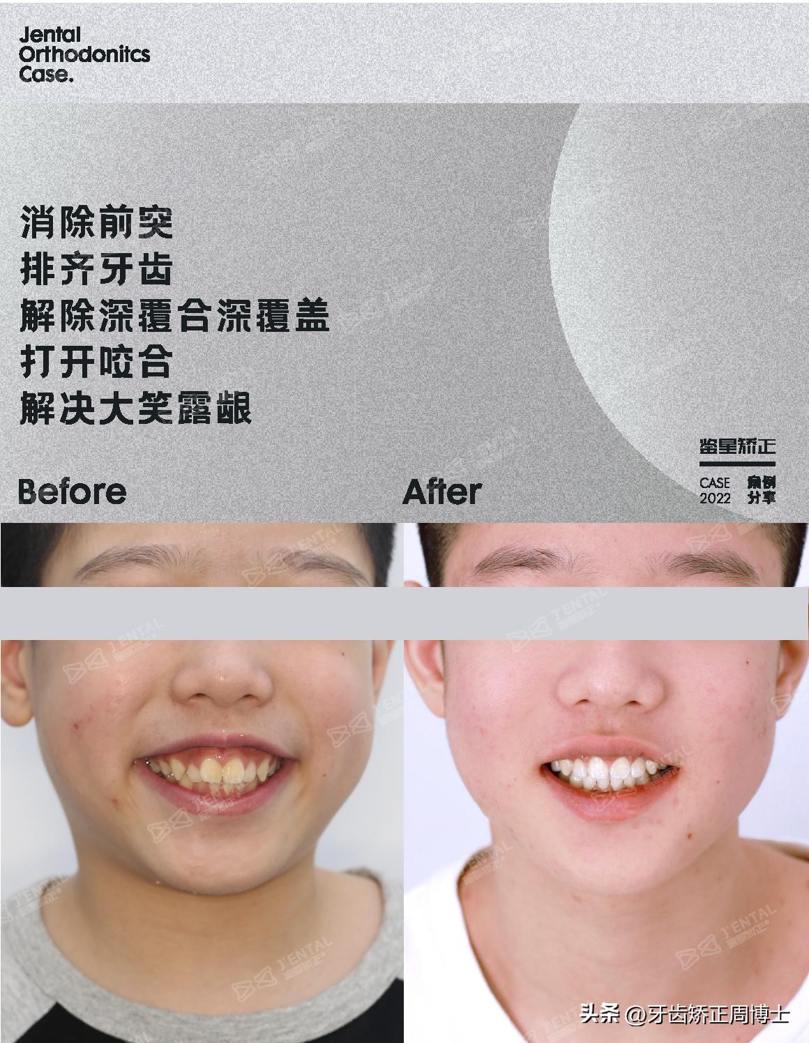 mrc戴上后不能闭上嘴怎么办,mrc矫正能用到几岁